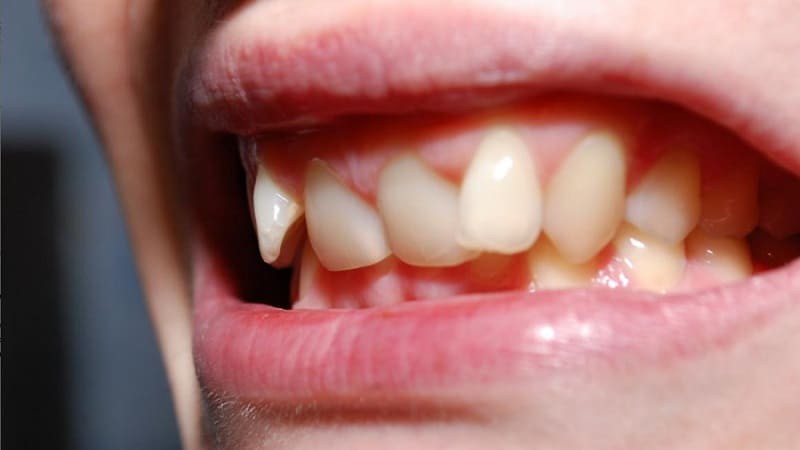 عوارض کج شدن دندان کودک | بهترین ایمپلنت شهرکرد
