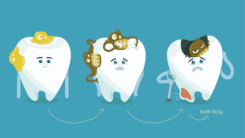 مهمترین دلایل پوسیدگی دندان | بهترین ایمپلنت شهرکرد