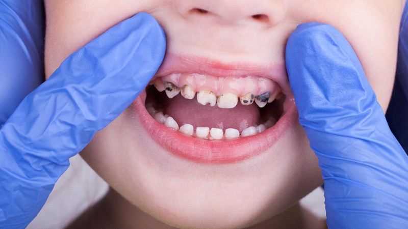 علل ایجاد پوسیدگی در دندان كودكان | بهترین ایمپلنت شهرکرد