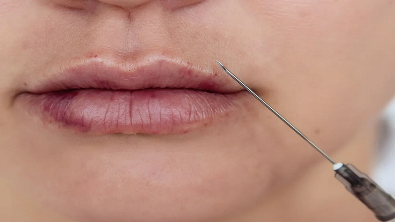 Lip bruise after gelبهترین ایمپلنت شهرکرد | بهترین ایمپلنت اصفهان | injection