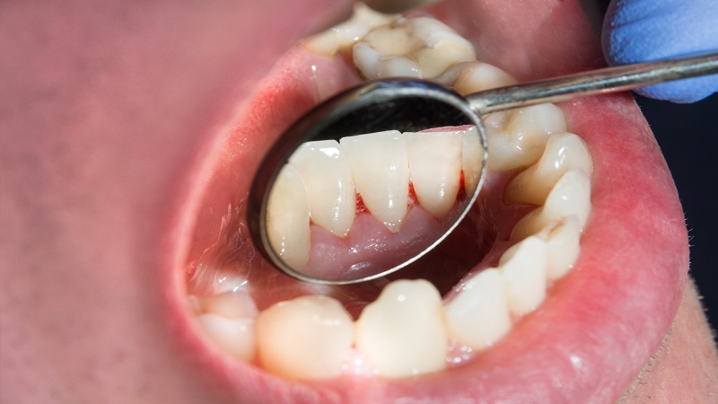 چگونه از تحلیل لثه پس از کاشت ایمپلنت دندان جلوگیری کنیم؟