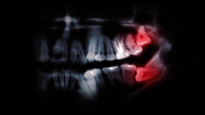  بهترین ایمپلنت اصفهان | بهترین ایمپلنت شهرکرد | دکتر مهران دانشمند | . دندان عقل افقی - علل و درمان