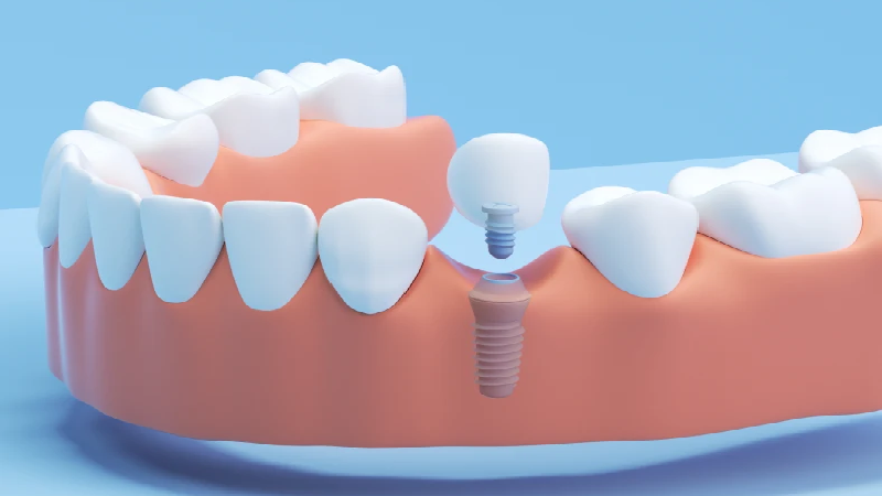بهترین ایمپلنت اصفهان | بهترین ایمپلنت شهرکرد | دکتر مهران دانشمند | ضمانت قطعات و گارانتی عملکرد ایمپلنت دندان
