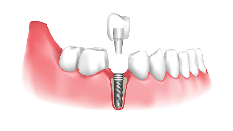بهترین ایمپلنت اصفهان | بهترین ایمپلنت شهرکرد | دکتر مهران دانشمند | کاشت ایمپلنت دندان