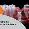 عوارض شایع کاشت ایمپلنت دندان