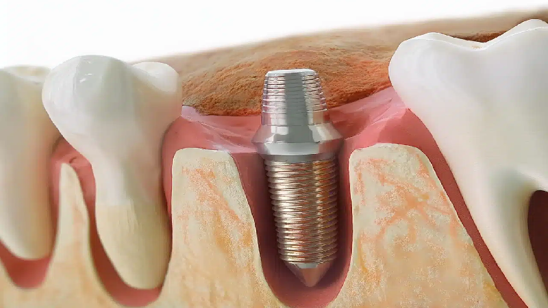 بهترین ایمپلنت اصفهان | بهترین ایمپلنت شهرکرد | دکتر مهران دانشمند | بروز حساسیت به ایمپلنت دندان