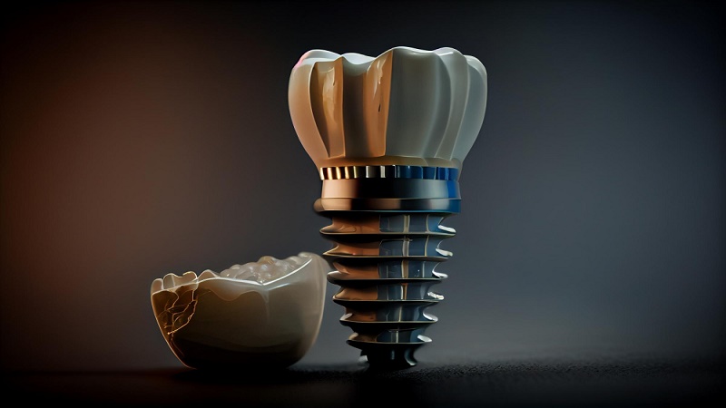 بهترین ایمپلنت اصفهان | بهترین ایمپلنت شهرکرد | دکتر مهران دانشمند | بهترین برندهای سوئیسی ایمپلنت دندان