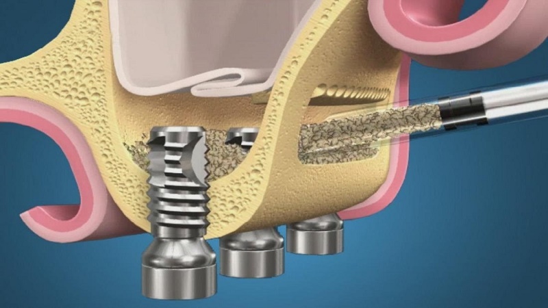 بهترین ایمپلنت اصفهان | بهترین ایمپلنت شهرکرد | دکتر مهران دانشمند | سینوس لیفت باز - جراحی کمی عمیق‌تر