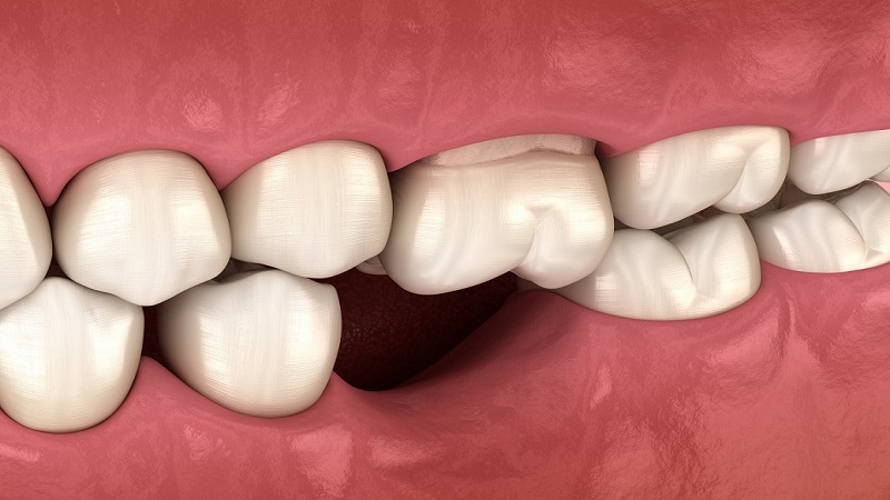 بهترین ایمپلنت اصفهان | بهترین ایمپلنت شهرکرد | دکتر مهران دانشمند | مخرب‌ترین عواقب بی‌ دندانی