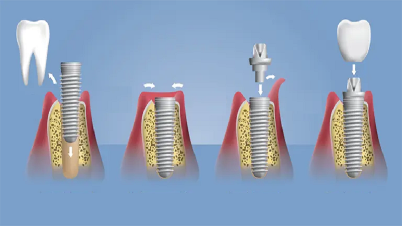بهترین ایمپلنت اصفهان | بهترین ایمپلنت شهرکرد | دکتر مهران دانشمند | مراحل ایمپلنت دندان