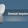 بهترین ایمپلنت اصفهان | بهترین ایمپلنت شهرکرد | دکتر مهران دانشمند | مزایای ایمپلنت دندان نسبت به درمان های جایگزین