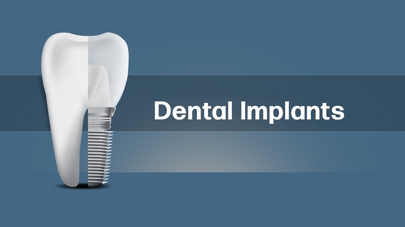 بهترین ایمپلنت اصفهان | بهترین ایمپلنت شهرکرد | دکتر مهران دانشمند | مزایای ایمپلنت دندان نسبت به درمان های جایگزین
