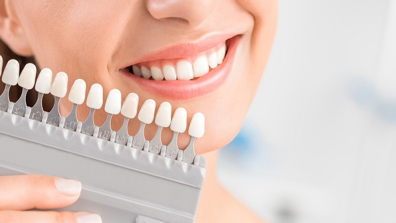 معیارهای اصلی انتخاب رنگ روکش ایمپلنت