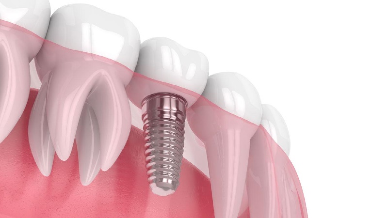 بهترین ایمپلنت اصفهان | بهترین ایمپلنت شهرکرد | دکتر مهران دانشمند | ملاک های لازم برای برای کاشت ایمپلنت دندان