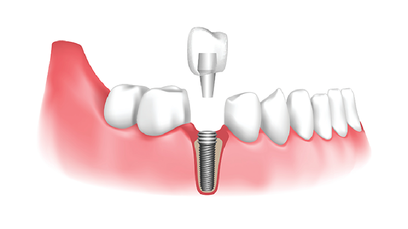 بهترین ایمپلنت اصفهان | بهترین ایمپلنت شهرکرد | دکتر مهران دانشمند | ایمپلنت دندان بهترین انتخاب برای کسانی که با MS زندگی می‌کنند .