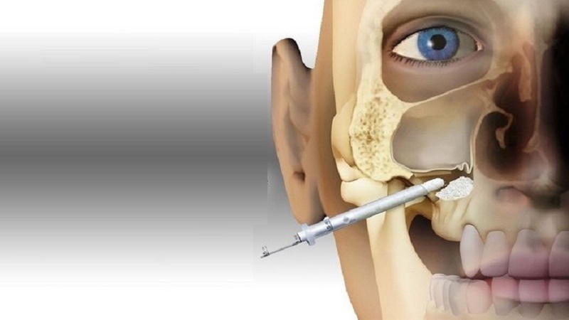 بهترین ایمپلنت اصفهان | بهترین ایمپلنت شهرکرد | دکتر مهران دانشمند | جراحی سینوس لیفت بسته