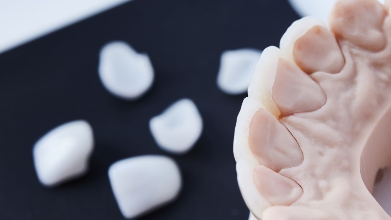 بهترین ایمپلنت اصفهان | بهترین ایمپلنت شهرکرد | دکتر مهران دانشمند | عوامل موثر در طول عمر چسب روکش دندان