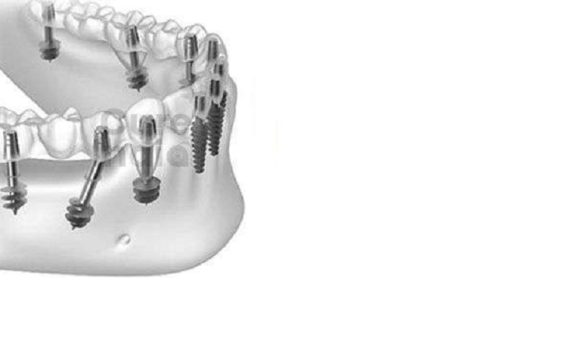 مزیت اصلی ایمپلنت : جلوگیری از تحلیل استخوان فک