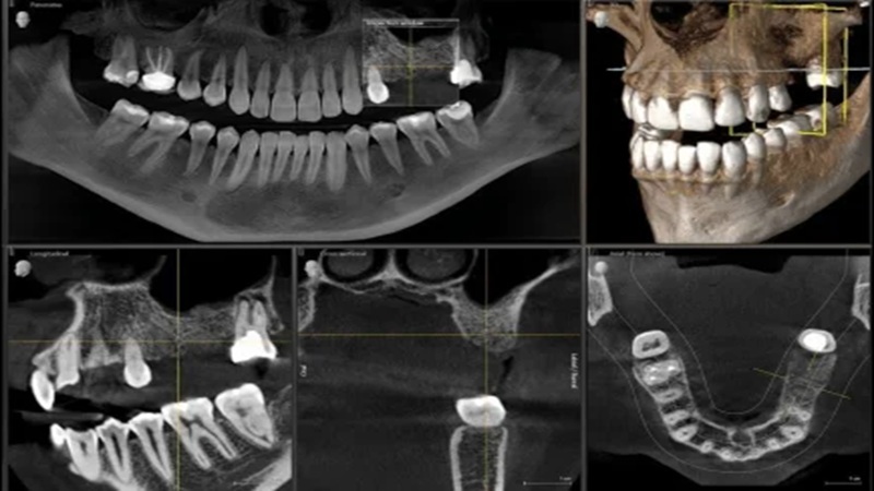 عکس CBCT چیست؟ | دکتر مهران دانشمند | بهترین ایمپلنت اصفهان | بهترین ایمپلنت شهرکرد