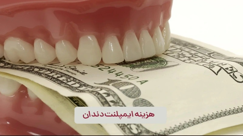 هزینه ایمپلنت دندان | دکتر مهران دانشمند | بهترین ایمپلنت اصفهان | بهترین ایمپلنت شهرکرد